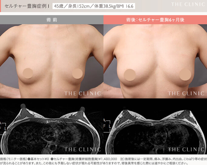 セルチャー豊胸の症例