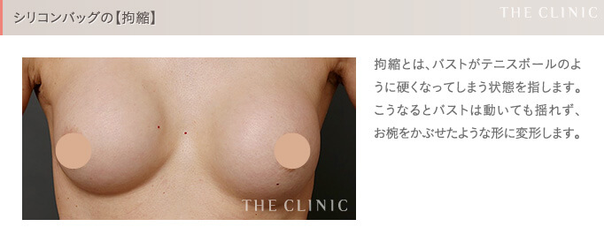 シリコンバッグ豊胸の失敗(拘縮)