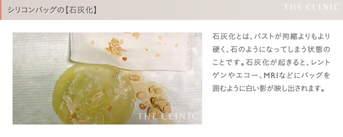 シリコンバッグ豊胸の失敗(石灰化)