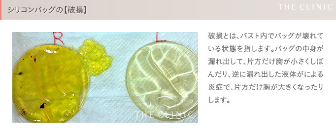 シリコンバッグ豊胸の失敗(破損)