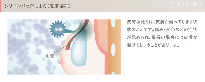 シリコンバッグ豊胸の失敗(皮膚壊死)