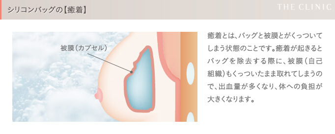 シリコンバッグ豊胸の失敗(癒着)