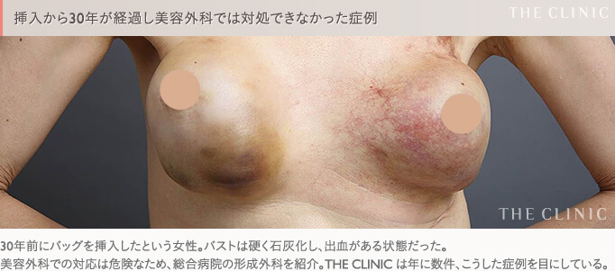 30年前にシリコンバッグ豊胸を受けた女性のバスト