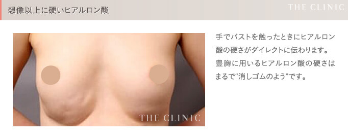ヒアルロン酸豊胸の失敗(想像以上に硬い)