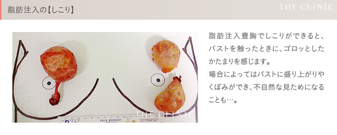 脂肪注入豊胸の失敗(しこり)