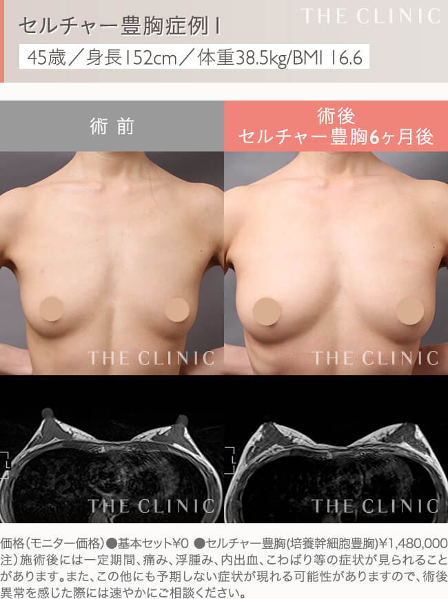 セルチャー豊胸の症例