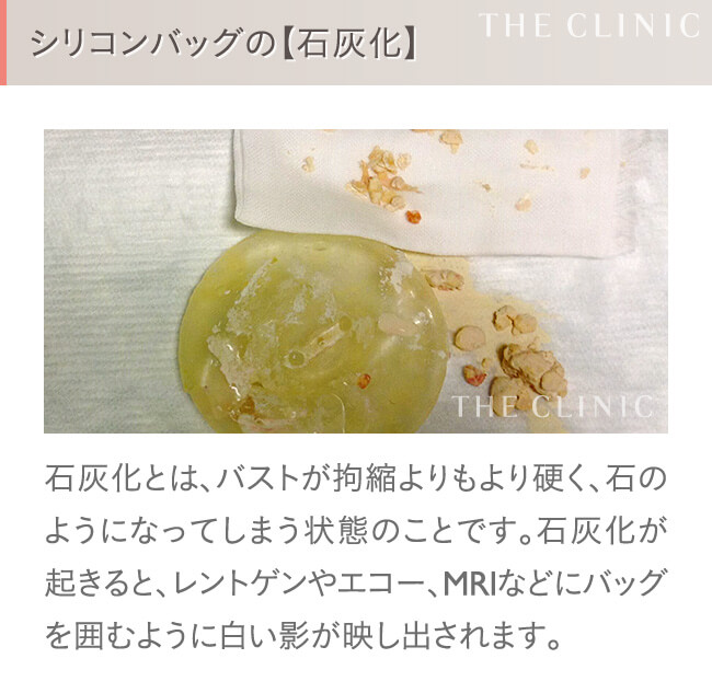 シリコンバッグ豊胸の失敗(石灰化)