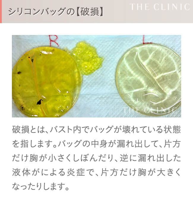 シリコンバッグ豊胸の失敗(破損)