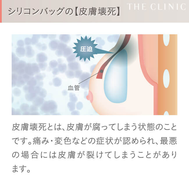 シリコンバッグ豊胸の失敗(皮膚壊死)