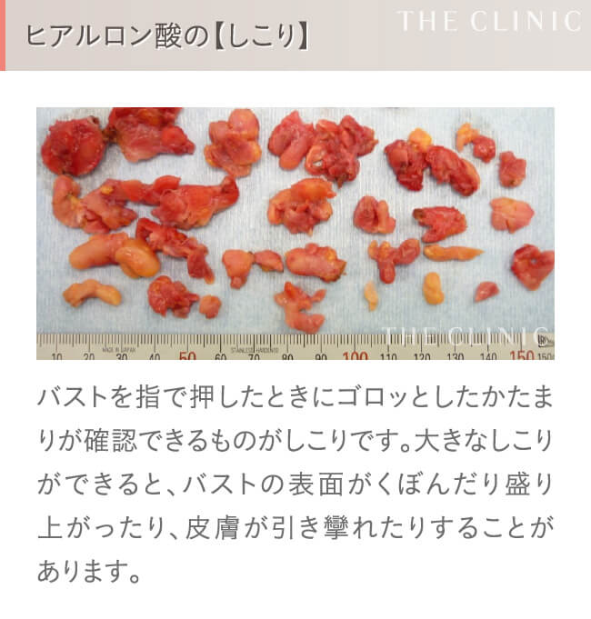 ヒアルロン酸豊胸の失敗(しこり)