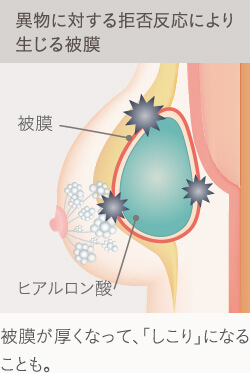 ヒアルロン豊胸で起こる拒否反応