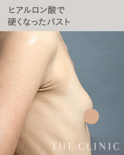 ヒアルロン酸豊胸で硬くなったバスト