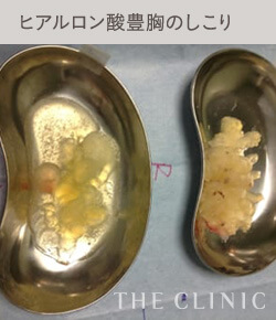ヒアルロン酸豊胸のしこり