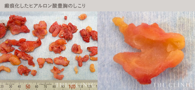 ヒアルロン酸豊胸でできたしこりの瘢痕化