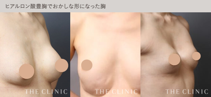 ヒアルロン酸豊胸で不自然な触感や形になったバスト