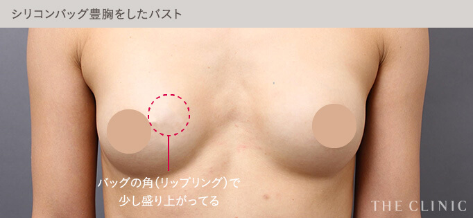 シリコンバッグ豊胸で不自然になったバスト
