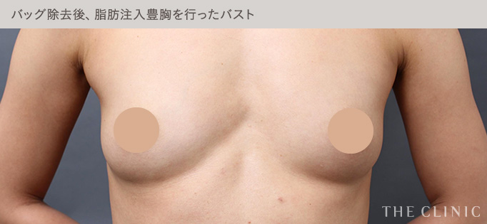 脂肪注入豊胸後の自然なバスト