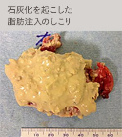 脂肪注入豊胸のしこりが石灰化した例