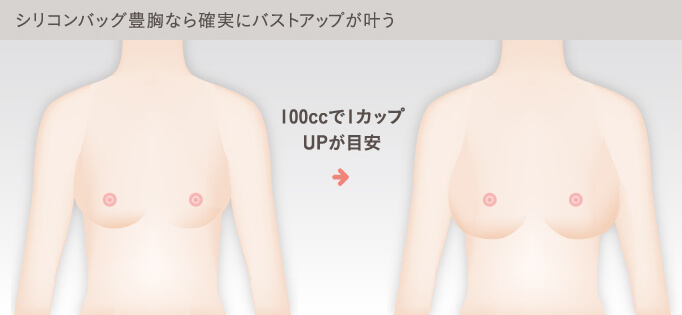 シリコンバッグ豊胸のメリット
