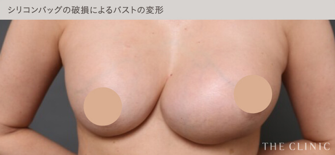 シリコンバッグの破損で腫れたバスト