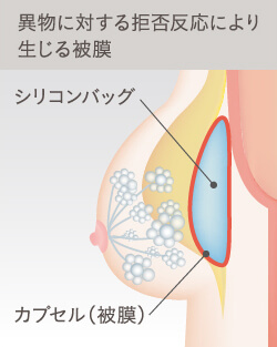 大きなシリコンバッグを追加した時のバスト