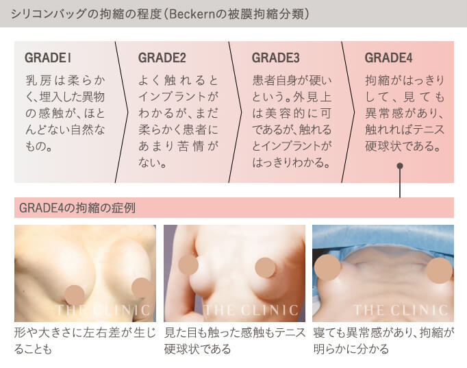 シリコンバッグ豊胸の拘縮