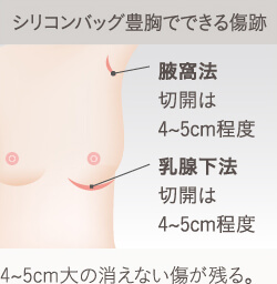 シリコンバッグ豊胸のデメリット：傷跡