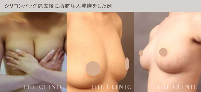 シリコンバッグ豊胸を脂肪注入豊胸に置き換えた症例