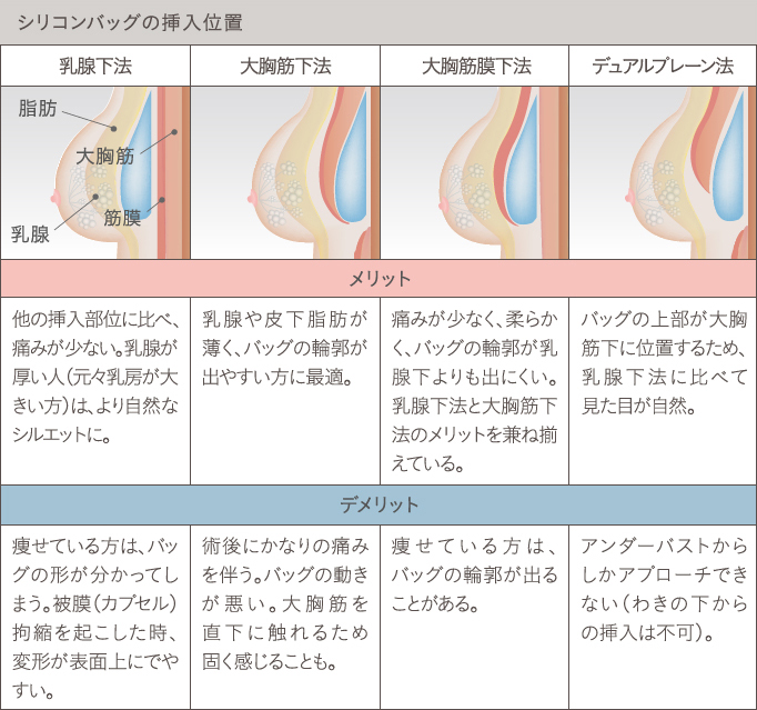 シリコンバッグ豊胸の挿入位置