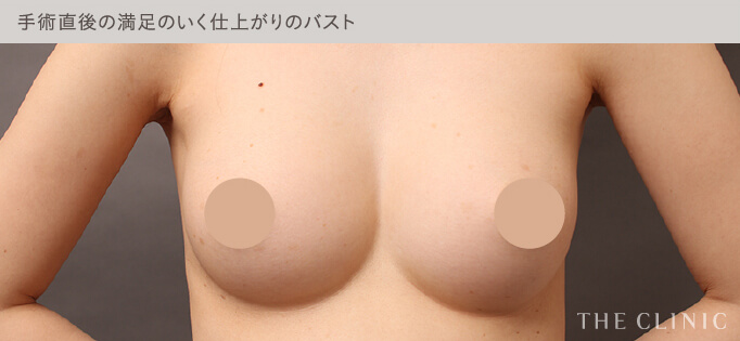 シリコンバッグ豊胸したバスト（成功例）