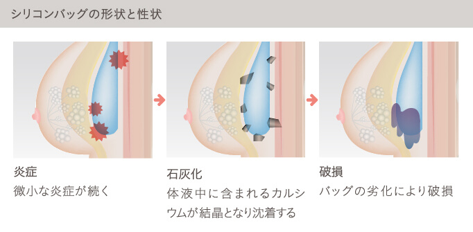 シリコンバッグ豊胸の術後の経過