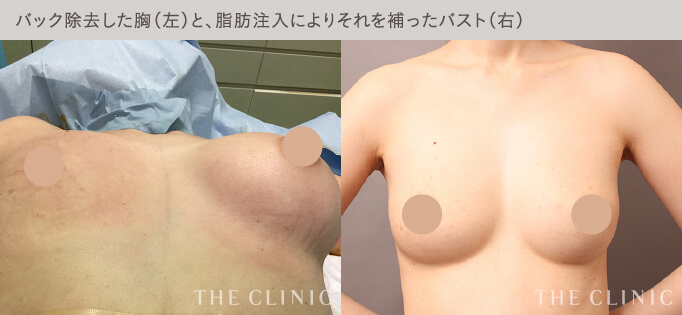 シリコンバッグ豊胸に成功した6年後にバッグを除去した例