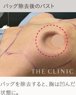 シリコンバッグ豊胸のデメリット：胸の変形